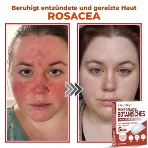 Oveallgo® MicroNeedle PLUS Botanical Day Clear Patch