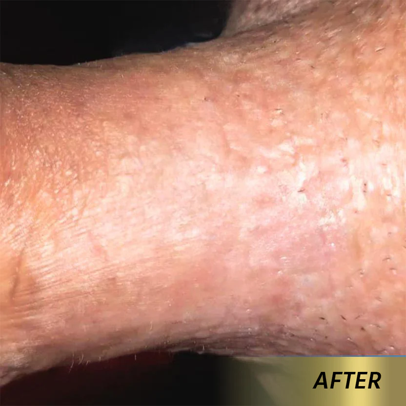 Oveallgo® AHCC Mushroom HPV Genital Warts Eraser Spray