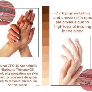 Oveallgo™ Therapy Oil for Acanthosis Nigricans