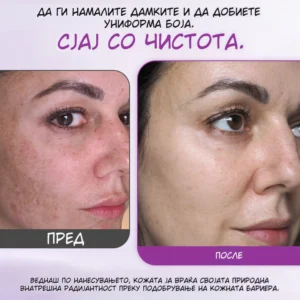 MelantraX – Advanced essence against pigmentation spots