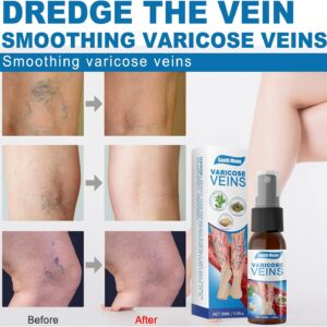 Goodbye Veins - Varicose Veins Spray
