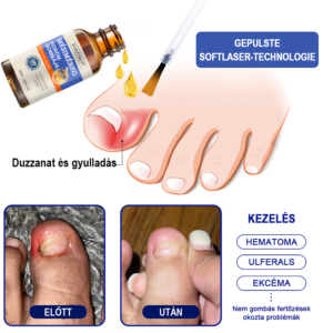 Furzero™ Bee Venom Nail Fungus Treatment Solution