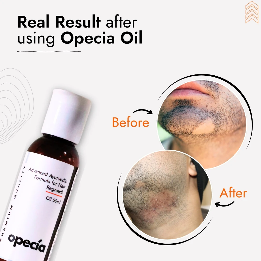 Advanced Formula For Alopecia Treatment