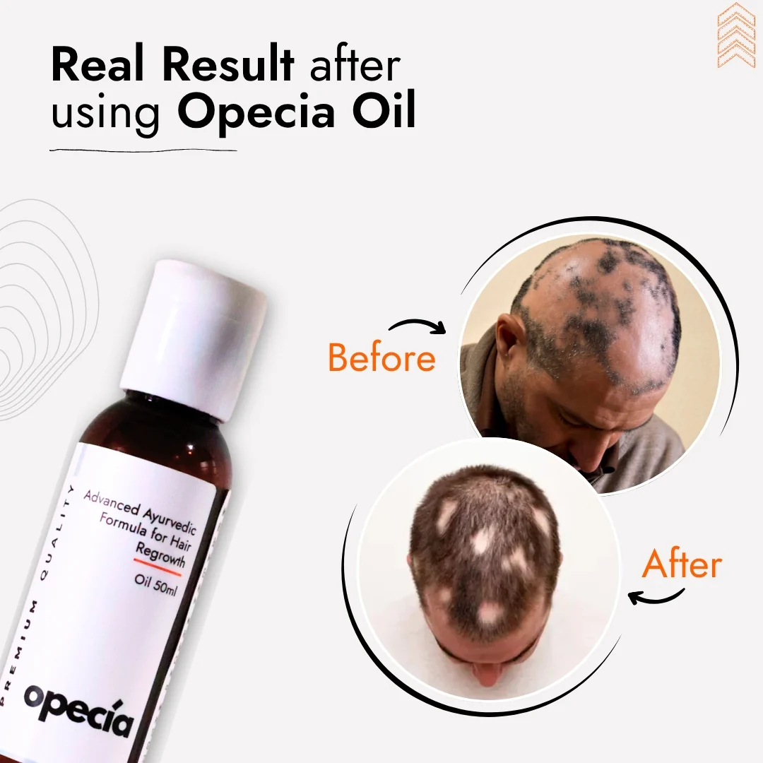 Advanced Formula For Alopecia Treatment