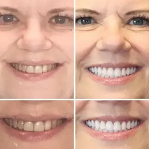 SMILE HZA™ Premium Denture