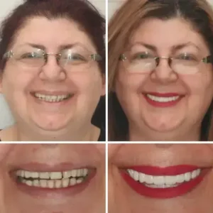 SMILE HZA™ Premium Denture