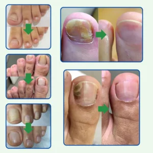 100% Natural Anti-Fungal Treatment