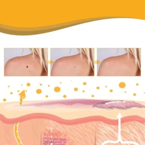 Wart & Skin Tag Remover Spray