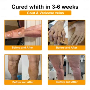 XRLXRL® Bee-Venom Pain-Relief Bone Healing Cream