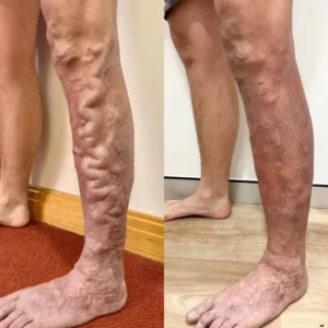 Herbal Varicose Vein Relief & Leg Comfort Cream