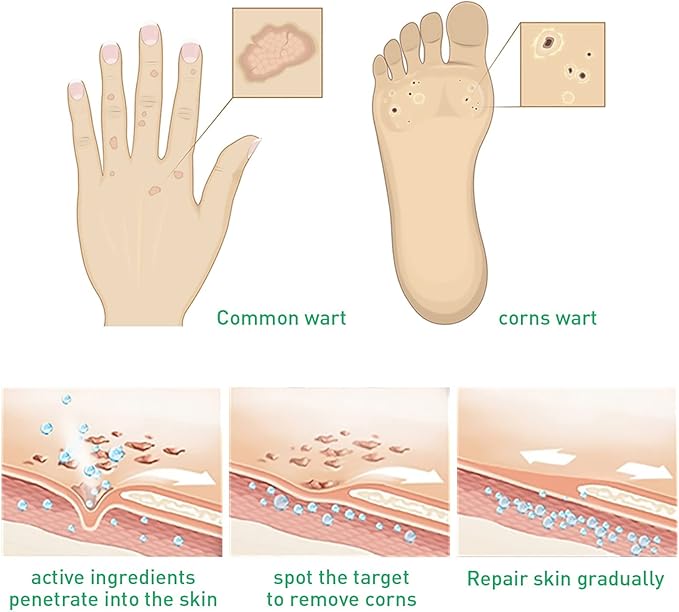 JAYSUING Effective Skin Corns Wart Remover Liquid Serum 1c1e21" face="Roboto, Arial, sans-serif">????কর্ন এবং কলাস হল ত্বকের পুরু, শক্ত স্তর যা ত্বক যখন ঘর্ষণ বা চাপ থেকে নিজেকে রক্ষা করার চেষ্টা করে তখন তৈরি হয়। এগুলি প্রায়শই পা এবং পায়ের আঙ্গুলে বা হাত এবং আঙ্গুলে তৈরি হয়। কর্ন ব্যথাজনক হতে পারে, বিশেষ করে যখন চাপ প্রয়োগ করা হয় এবং আকার এবং চেহারায় ভিন্নতা থাকতে পারে।????