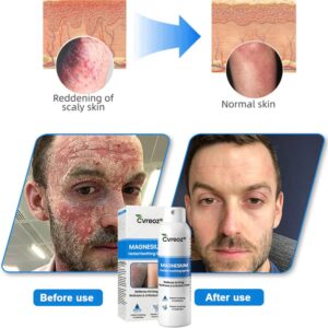 PsoriCalm Magnesium Soothing Spray