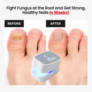 Laser Nail Fungus Treatment Device – Deep Penetration & Fast Repair
