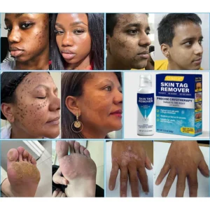 CVREOZ skin tag spray bottle