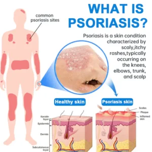 Cvreoz® Magnesium Herbal Psoriasis Spray