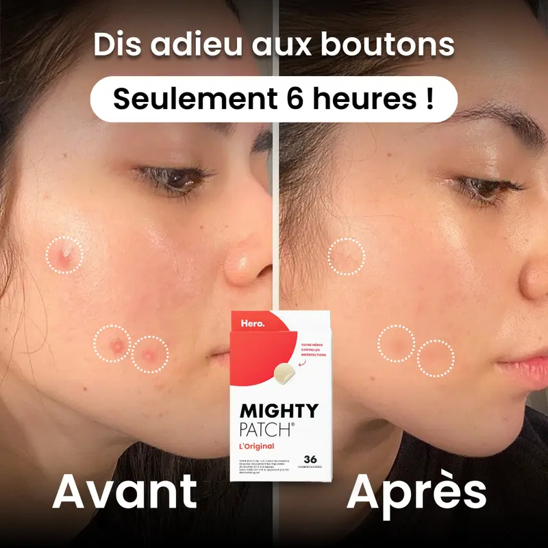 mighty patch blemish cover patch